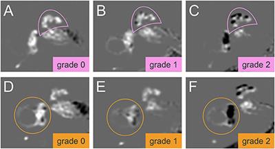 Endolymphatic Hydrops in Patients With Vestibular Migraine and Concurrent Meniere's Disease